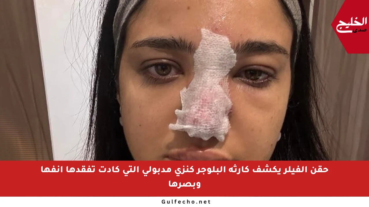 حقن الفيلر يكشف كارثة البلوجر كنزي مدبولي التي كادت تفقدها أنفها وبصرها